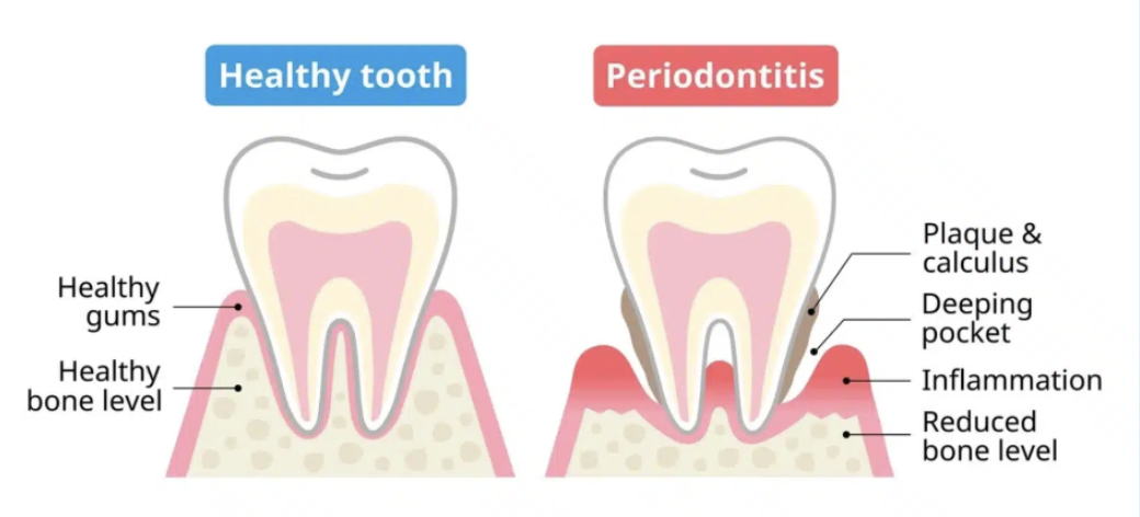 visual of what periodontal disease