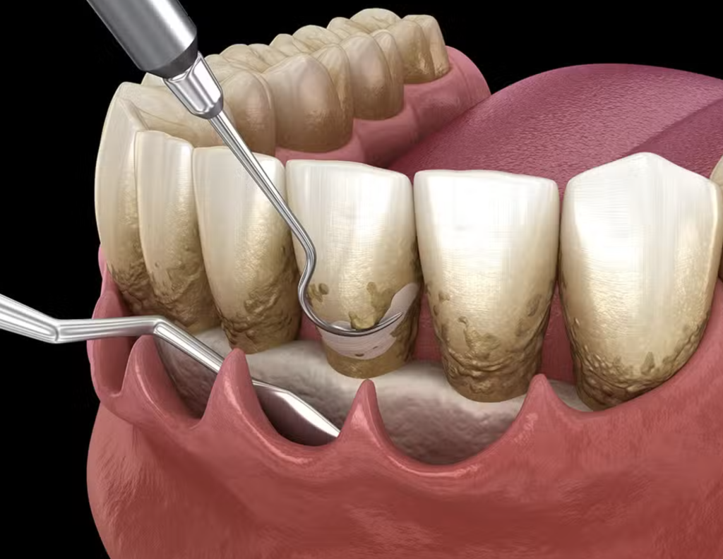 periodontal disease therapy